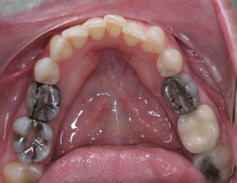 Mercury Silver filling replacment