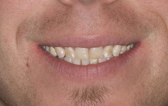 Composite Bonding and Porcelain Crowns