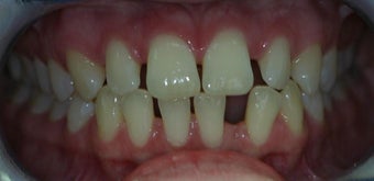 Porcelain Veneers and Composite Bonding