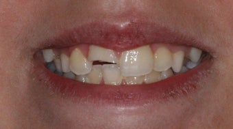 Cosmetic Composite Resin for Broken Front Tooth in Teenager