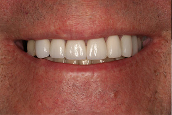 Full Porcelain Crowns