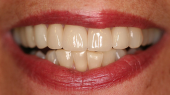 Full Porcelain Crowns