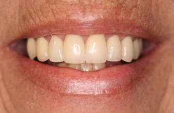 Full Porcelain Crowns