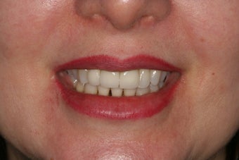 Anterior all-ceramic crowns and implant crowns