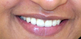 Ceramic Crowns for midline gap