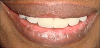 6 dental crowns to repair badly broken down teeth