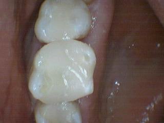 Silver Fillings Replaced with Porcelain