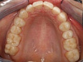 CEREC Restorations