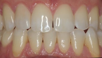 EMAX crown and extreme whitening treatment.