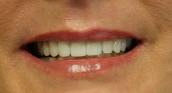 porcelain crowns