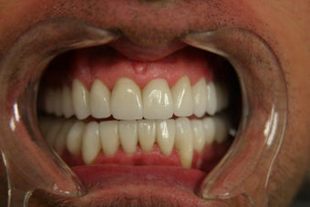 full mouth reconstruction