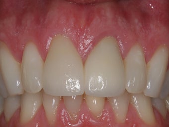 Anterior Crowns