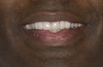 Porcelain Crowns