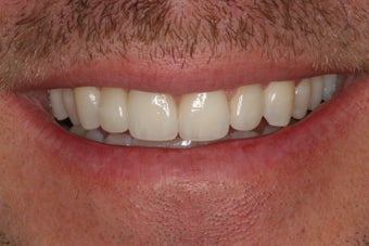 Tooth replacement in the smile