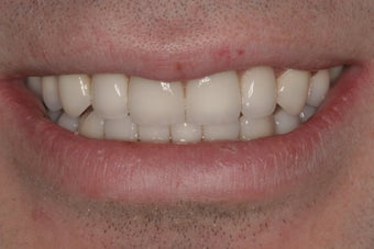 Full Mouth Reconstruction