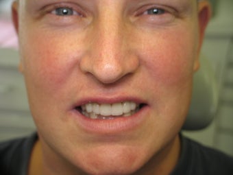 Cosmetic Porcelain Crowns