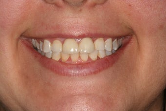 All-ceramic crowns for anterior teeth