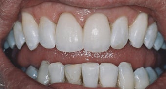 Dental Crowns and Teeth Whitening