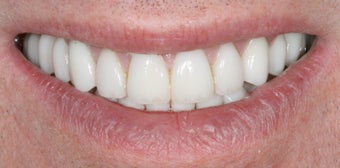 Porcelain veneers and crowns