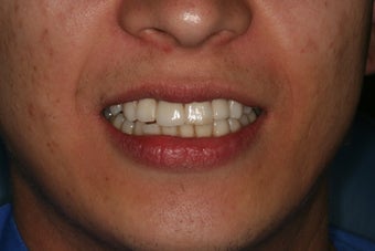 Anterior all ceramic crowns