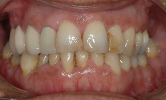 Full Porcelain Crowns