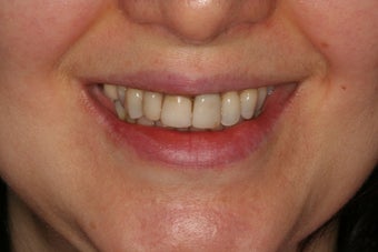 Anterior all-ceramic crowns and implant crowns