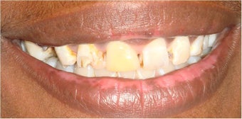 6 dental crowns to repair badly broken down teeth