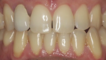 EMAX crown and extreme whitening treatment.