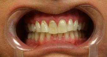 porcelain crowns
