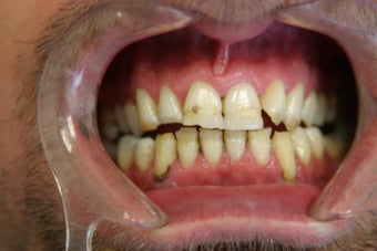full mouth reconstruction