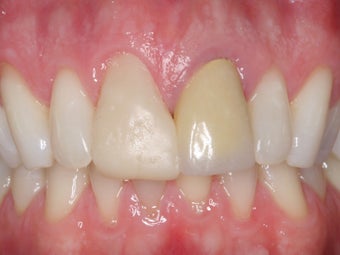 Anterior Crowns