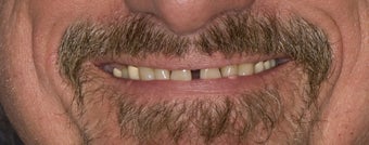 Porcelain Crowns 