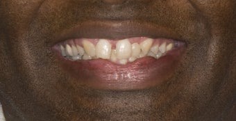 Porcelain Crowns