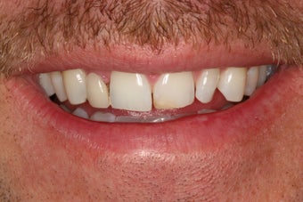 Tooth replacement in the smile