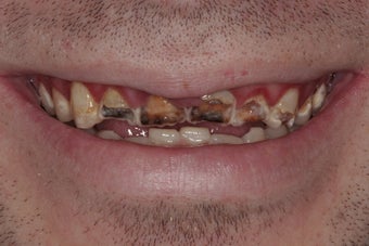 Full Mouth Reconstruction
