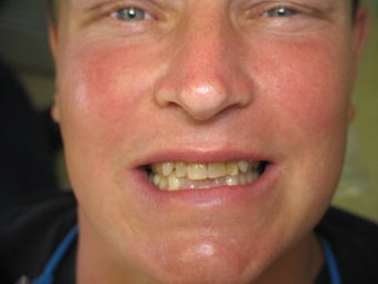 Cosmetic Porcelain Crowns