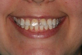 All-ceramic crowns for anterior teeth