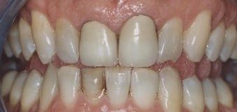 Dental Crowns and Teeth Whitening