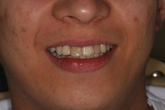 Anterior all ceramic crowns