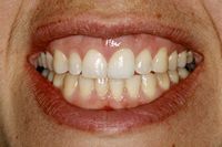 Dental Implants on the front tooth