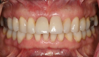 Anterior dental implant