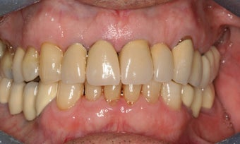 Full mouth reconstruction