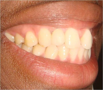 Replacing congenitally missing tooth with Dental Implant