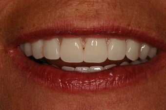Same day implant supported teeth.
