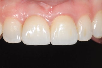 Single implant and crown in smile zone
