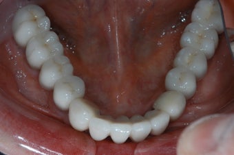 Full mouth dental implants with fixed porcelain bridge