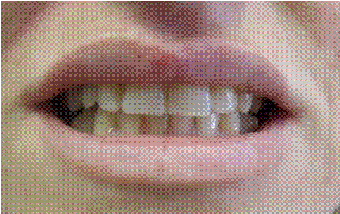Dental Implant replacing missing canine