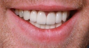 Trauma, Implants, Full Restoration