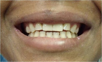 Mini Dental Implants replacing missing front teeth