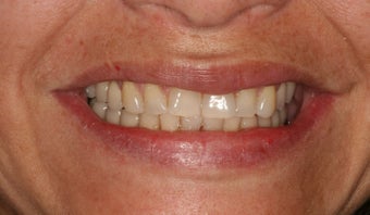 Implant restorations of posterior segments on the top and bottom
